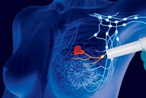 A Seriate i tumori millimetrici al seno operati grazie ad una nuova apparecchiatura